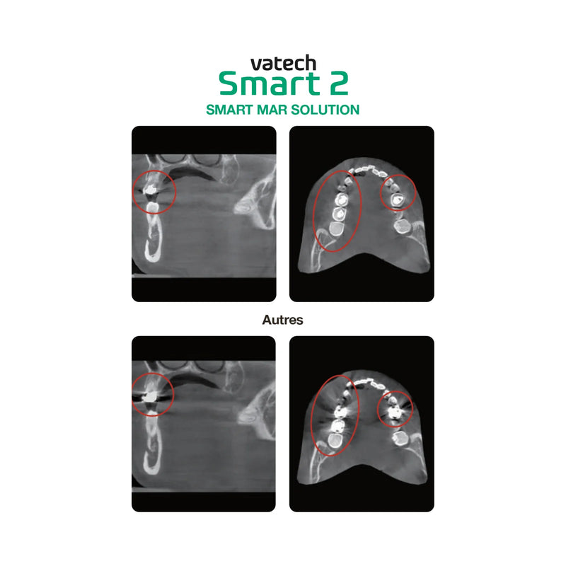 Système d’imagerie panoramique 3D / 2D - Smart 2 - Vatech - Safe Implant