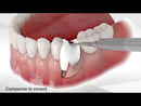 boîte 6x Bond Apatite™ comblement osseux instantané par Augma Biomaterials™ - Safe Implant