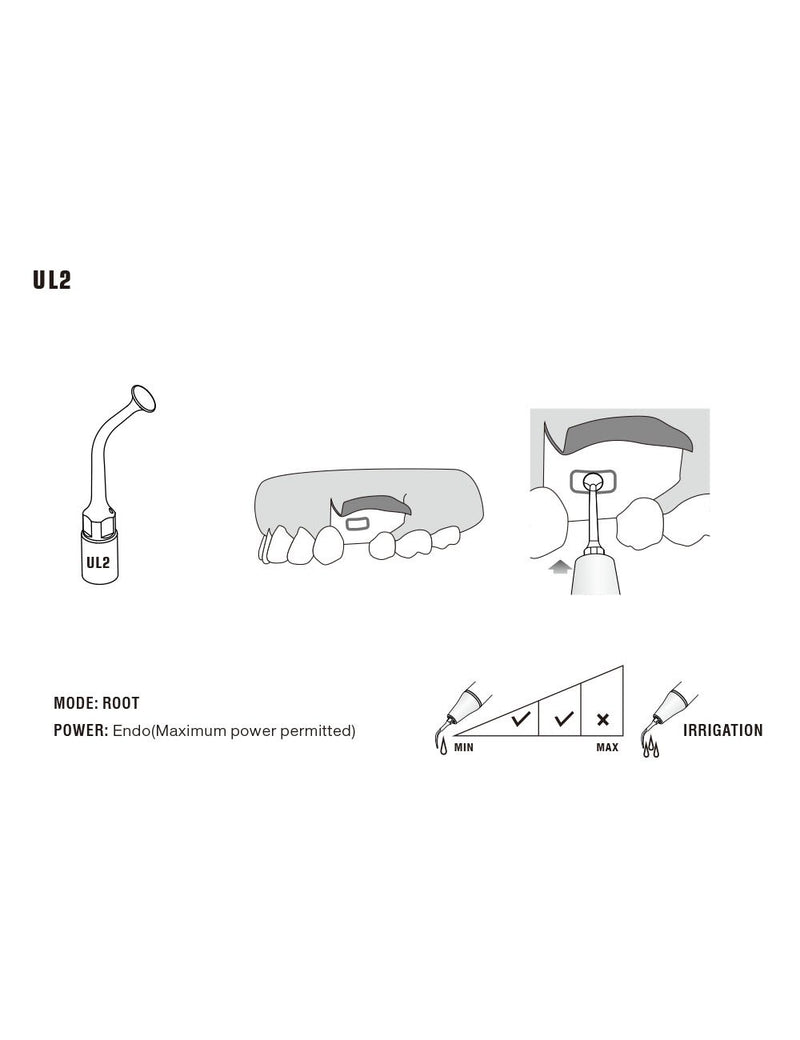 Insert UL2 pour chirurgie piezo - WOODPECKER - Safe Implant