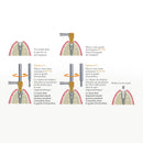 SOS Kit - Extraction rapide & sécurisée de vis d’implant cassées - Safe Implant