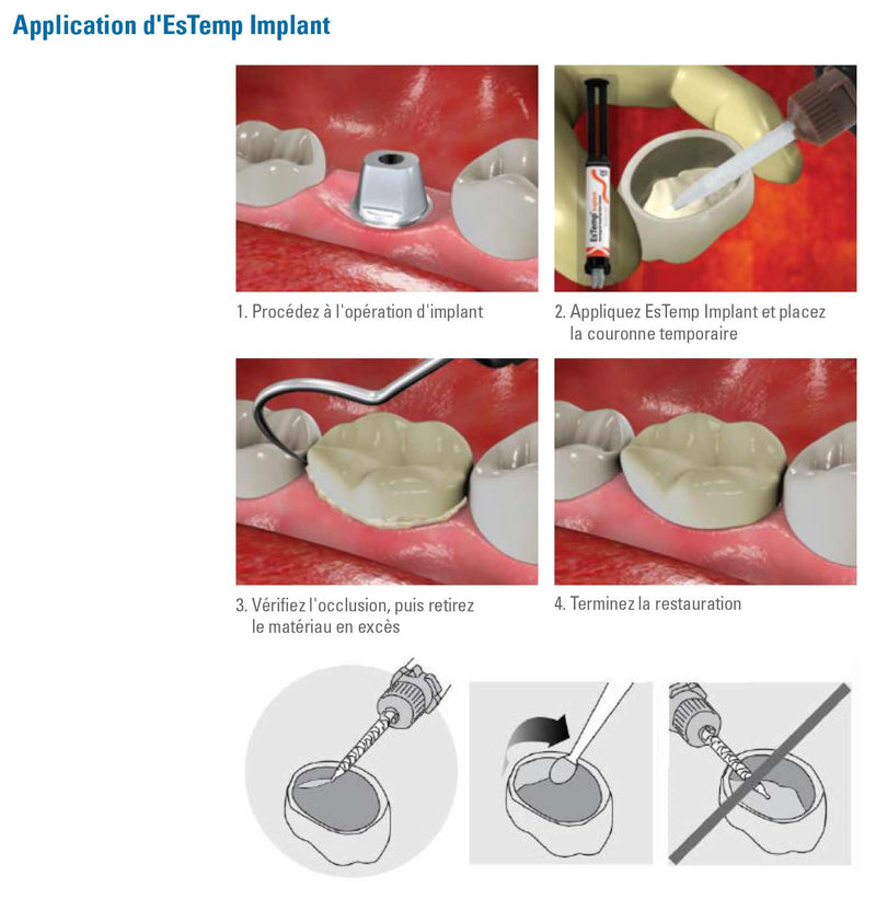 EsTemp Implant 1x 8g Ciment temporaire à base de résine sans eugénol pour les couronnes retenues par implants - Safe Implant